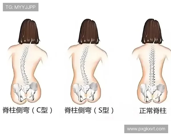 科学开展脊柱侧弯运动干预提升青少年体态健康水平与功能恢复方案 - 副本 (2)